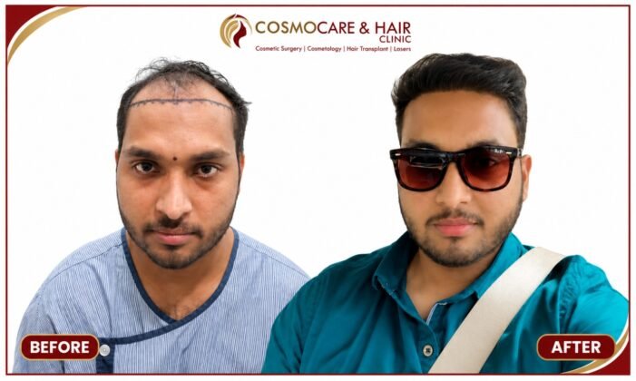 Hair restoration results