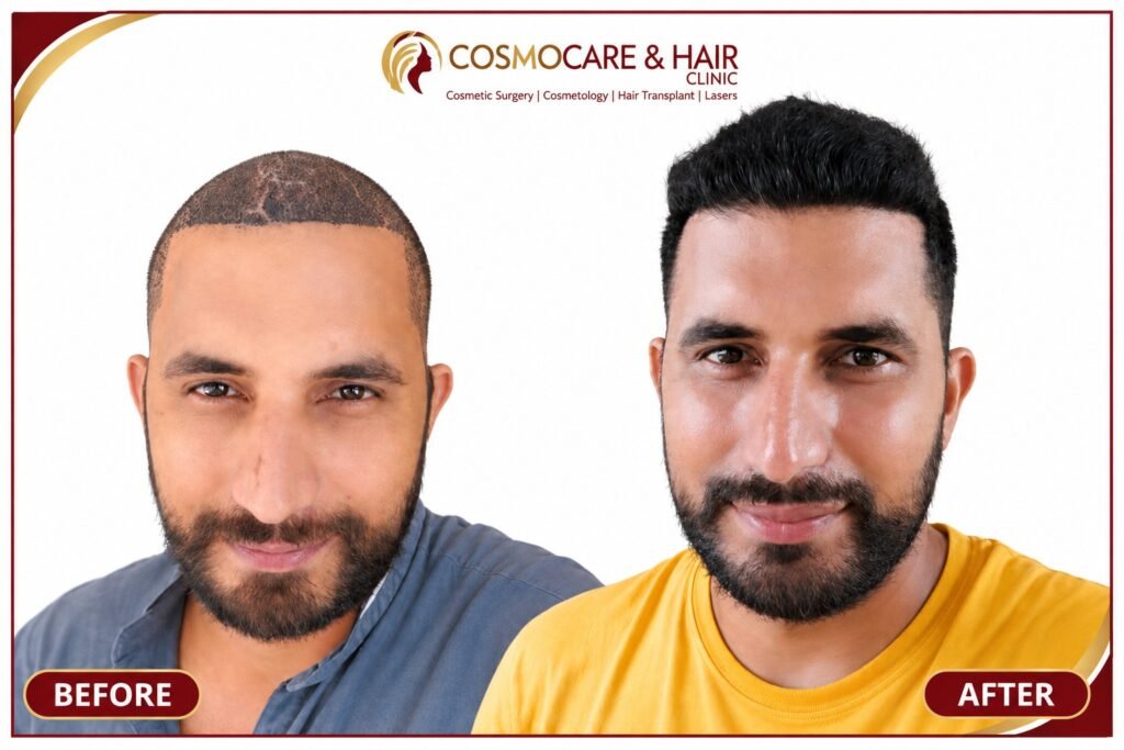 Hair transplant before and after