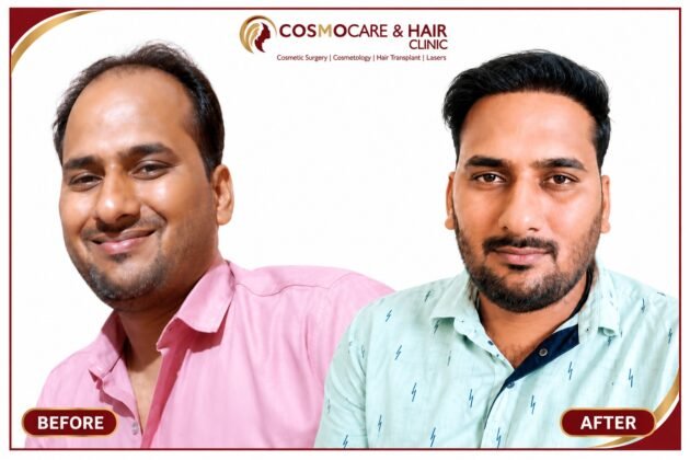 Hair transplant density improvement