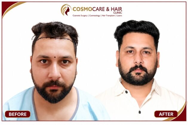 Hair transplant hairline results