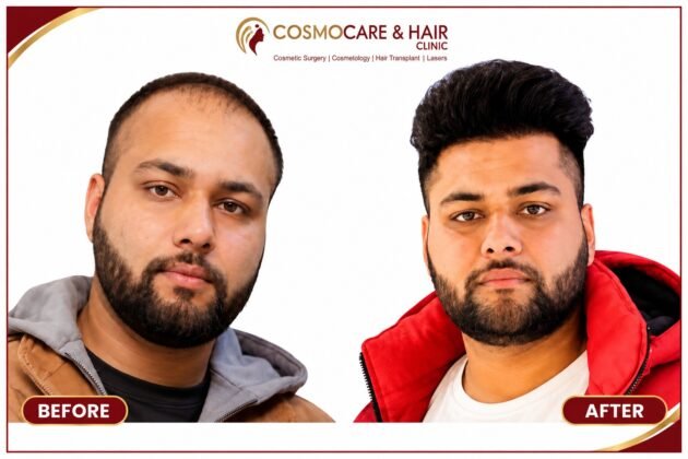 Hair transplant result showing improvement in the frontal scalp