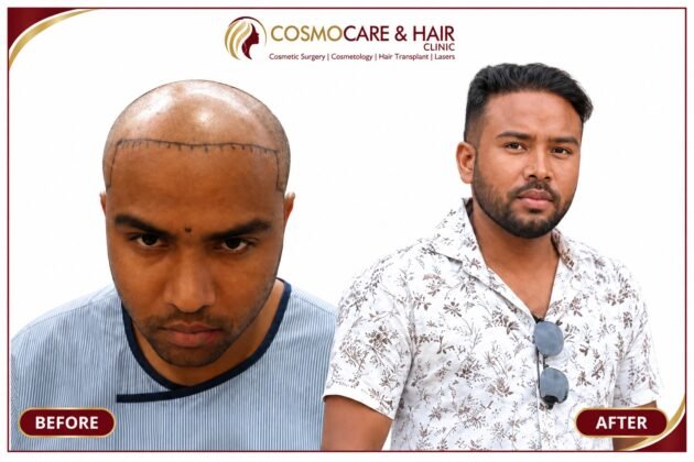 Hairline restoration results