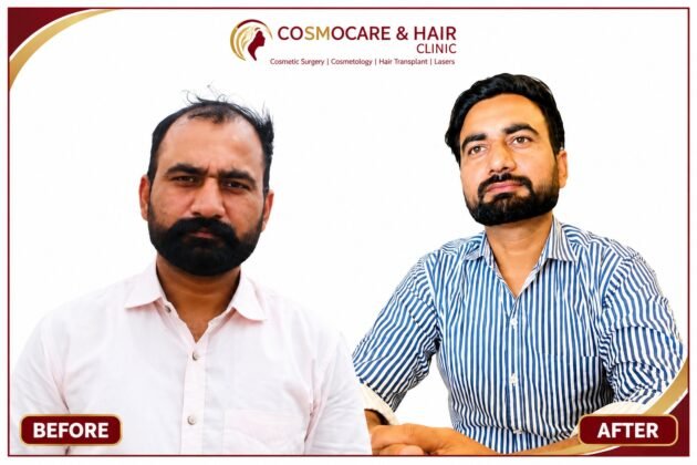 Improved hair density after transplant
