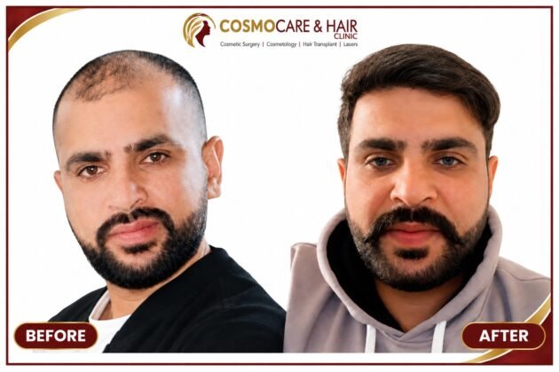 Natural hair transplant results