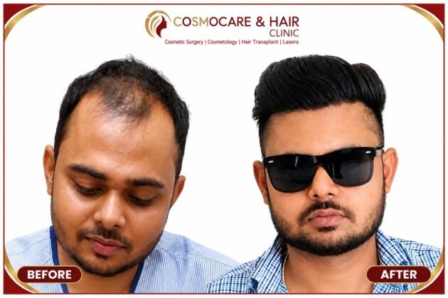 Professional hair restoration Chandigarh